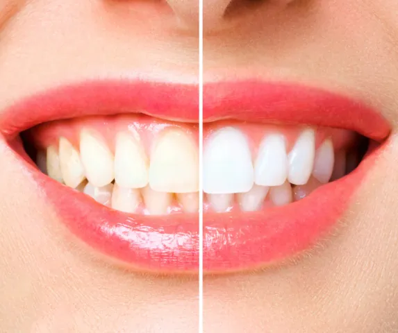 Zobu balināšana, pirms un pēc