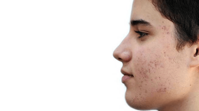 Acne Scars Removal in Delhi  Derma Miracle Clinic